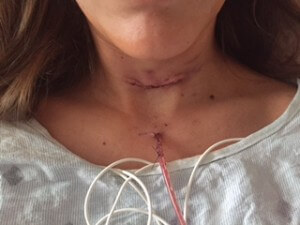 The incision initially after surgery.